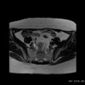 Bicornuate uterus- on MRI (Radiopaedia 49206-54297 Axial T2 2).jpg
