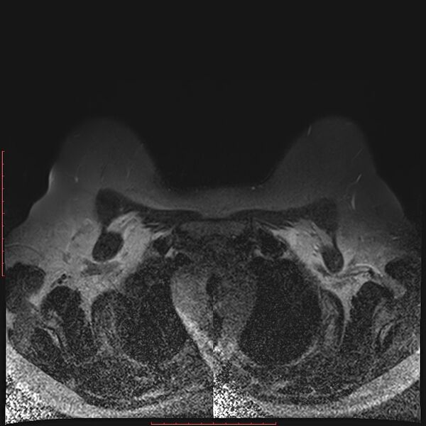 File:Bilateral breast implant rupture (Radiopaedia 24761-25027 T2 fat sat 5).jpg
