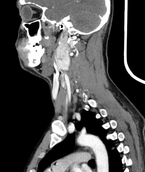 File:Bilateral carotid body tumors (Radiopaedia 52899-58827 C 39).jpg