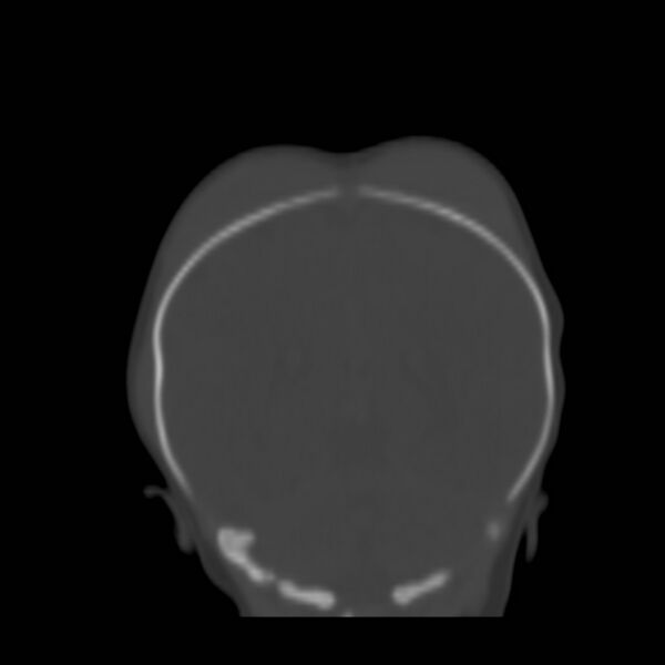 File:Bilateral cephalohematomas and subdural hematomas (Radiopaedia 26778-26929 Coronal bone window 21).jpg