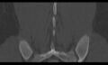 Bilateral pars defect (Radiopaedia 26691-26846 Coronal bone window 41).jpg