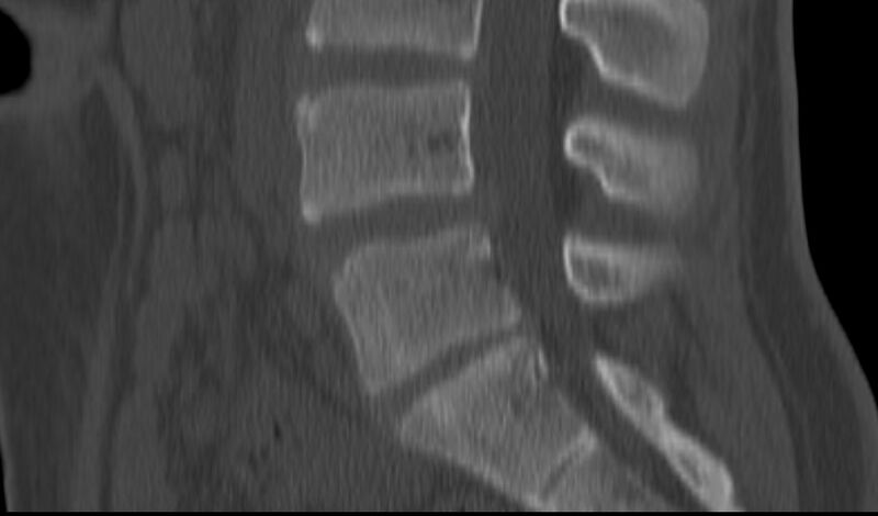 File:Bilateral pars defect (Radiopaedia 26691-26846 Sagittal bone window 32).jpg