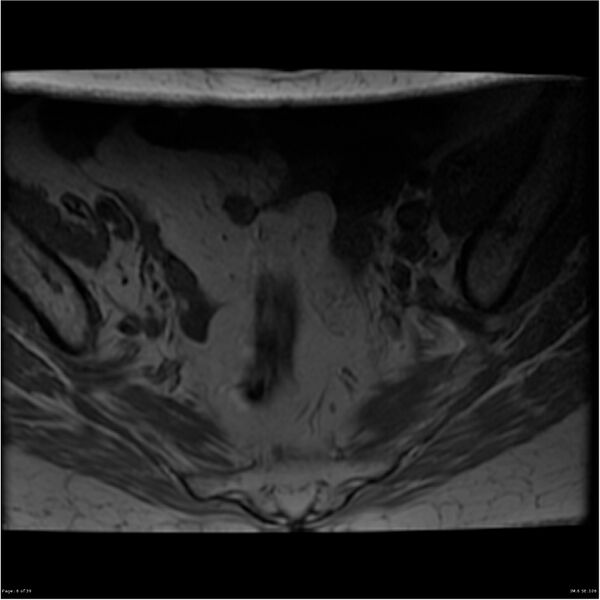 File:Bilateral psoas hematomas (Radiopaedia 24057-24280 T1 6).jpg