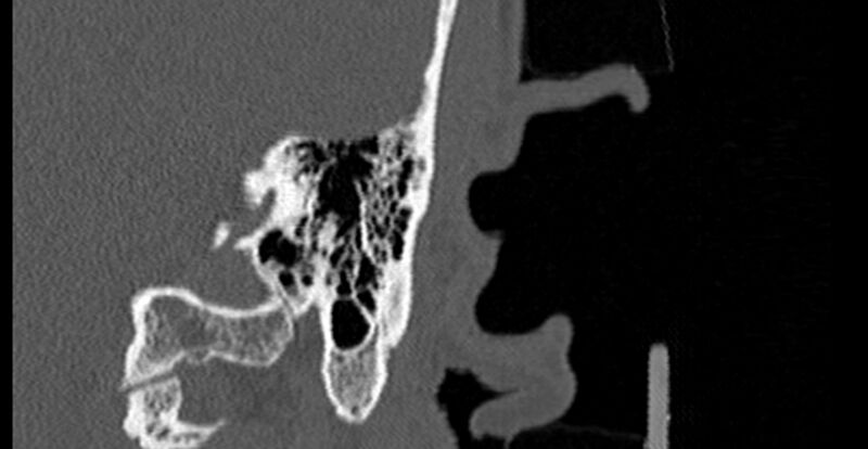 File:Bilateral temporal bone fractures (Radiopaedia 29482-29970 B 72).jpg