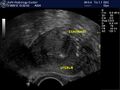 Bilateral tubal block and hydrosalpinx (Radiopaedia 23086-23117 A 5).jpg