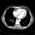 Biliary necrosis - liver transplant (Radiopaedia 21876-21846 B 1).jpg