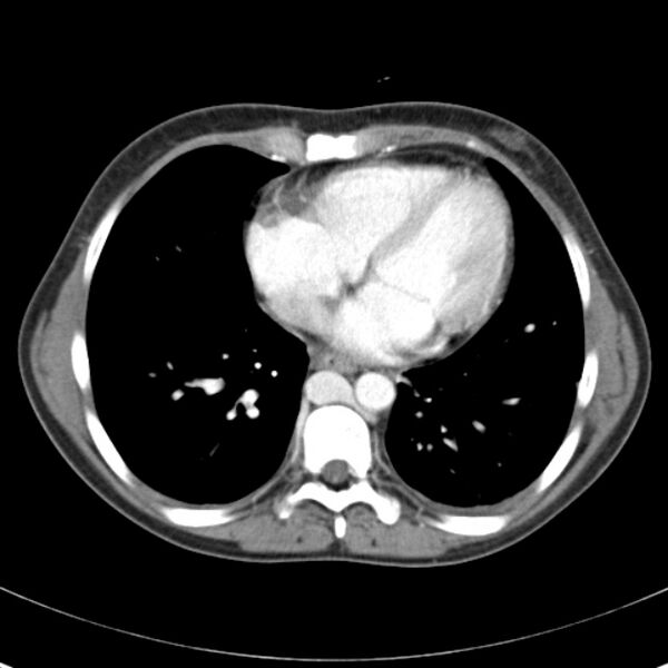 File:Biliary necrosis - liver transplant (Radiopaedia 21876-21846 B 1).jpg