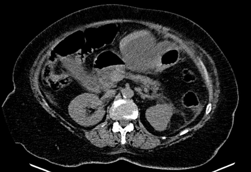 File:Biliary pancreatitis (Radiopaedia 72289-82823 Axial non-contrast 105).jpg