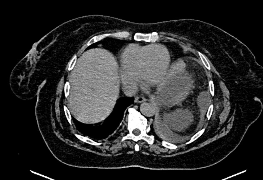 Biliary pancreatitis (Radiopaedia 72289-82823 Axial non-contrast 29).jpg