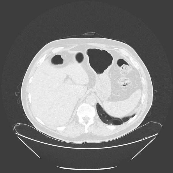 File:Birt-Hogg-Dubé syndrome (Radiopaedia 52578-58491 Axial lung window 60).jpg