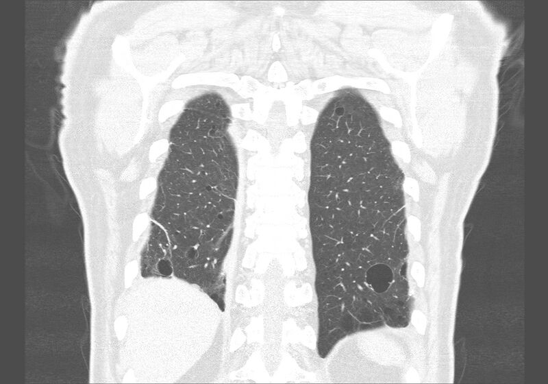 File:Birt-Hogg-Dubé syndrome (Radiopaedia 52578-58491 Coronal lung window 54).jpg
