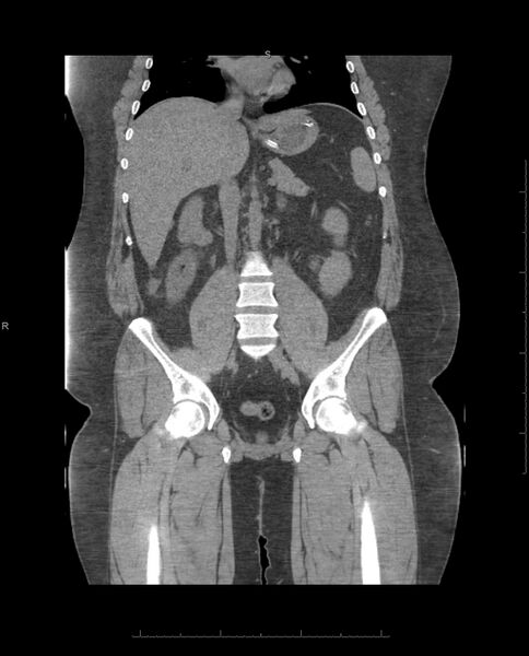 File:Bladder exstrophy - post surgery (Radiopaedia 35763-37314 Coronal non-contrast 1).jpg