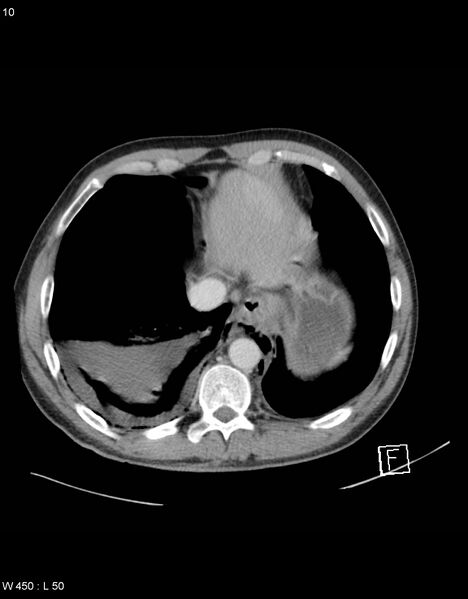 File:Boerhaave syndrome with tension pneumothorax (Radiopaedia 56794-63603 A 5).jpg