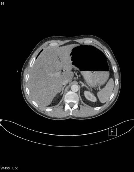 File:Boerhaave syndrome with tension pneumothorax (Radiopaedia 56794-63605 A 48).jpg