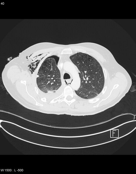File:Boerhaave syndrome with tension pneumothorax (Radiopaedia 56794-63605 Axial lung window 19).jpg