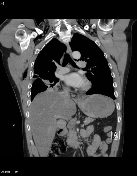File:Boerhaave syndrome with tension pneumothorax (Radiopaedia 56794-63605 B 18).jpg