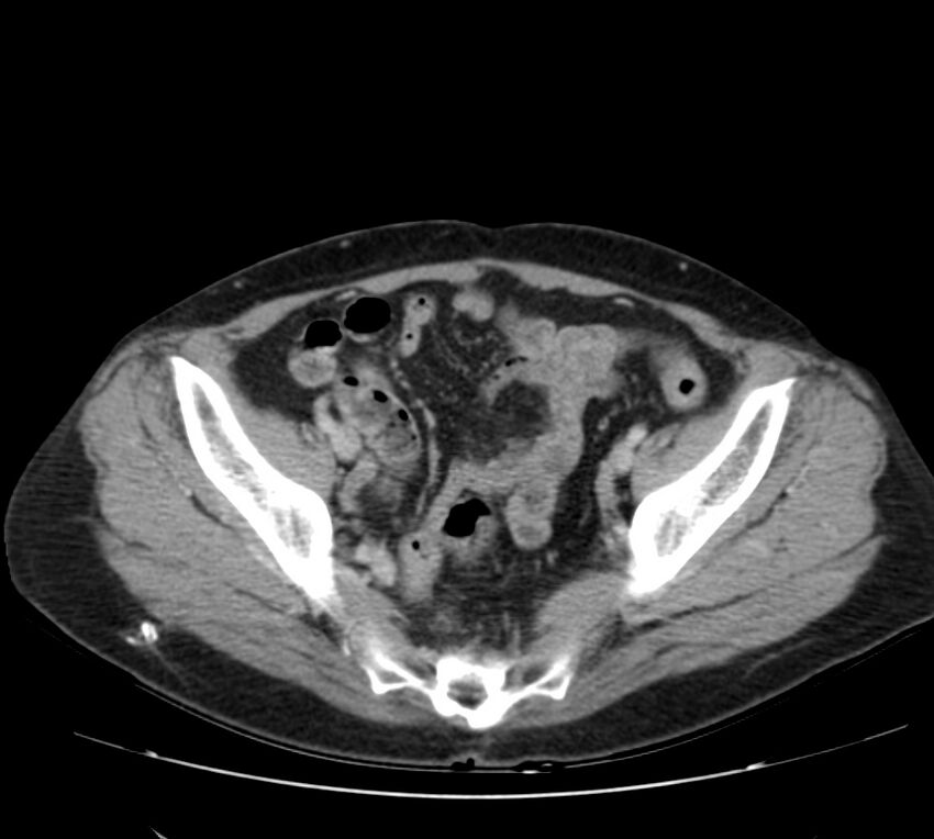 Bosniak renal cyst - type IV (Radiopaedia 22929-22953 C 55).jpg