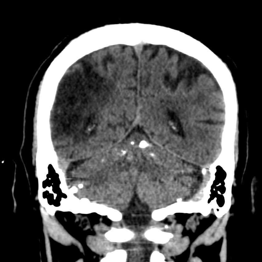 Brain Pantopaque remnants (Radiopaedia 78403-91048 Coronal non-contrast 51).jpg