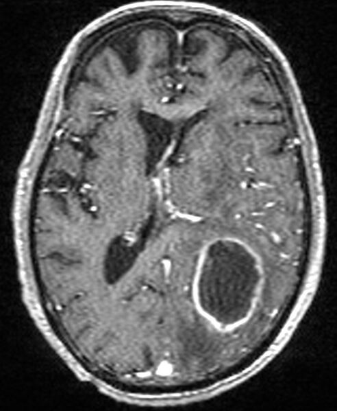 File:Brain abscess with dual rim sign (Radiopaedia 87566-103938 Axial T1 C+ 92).jpg