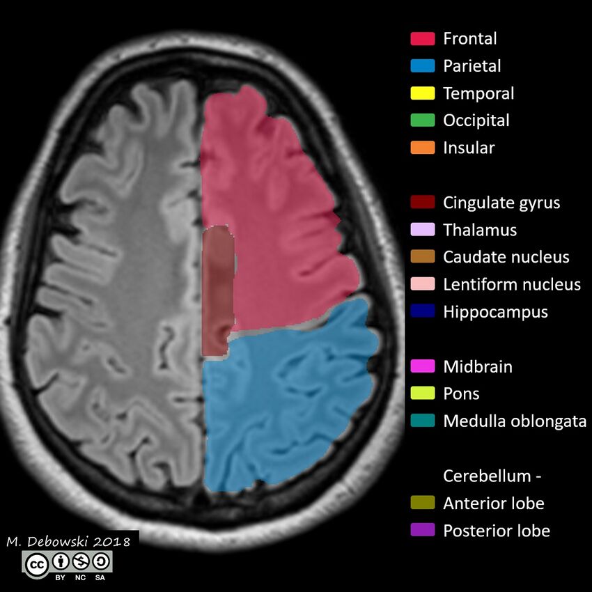 Brain lobes - annotated MRI (Radiopaedia 61691-69700 Axial 21).JPG