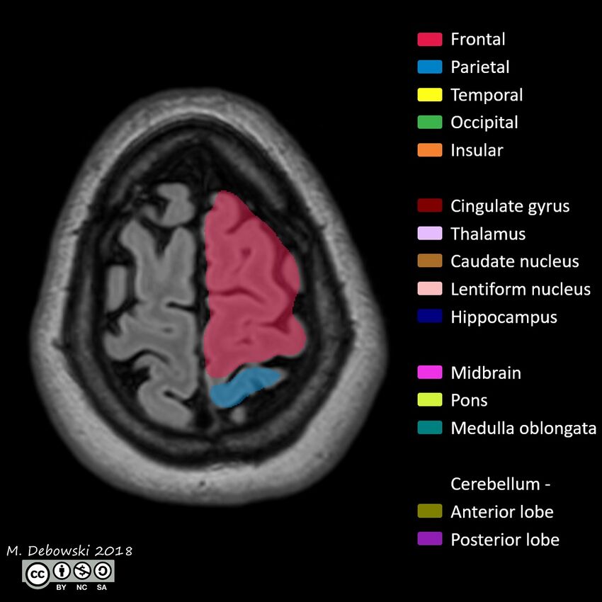 Brain lobes - annotated MRI (Radiopaedia 61691-69700 Axial 5).JPG