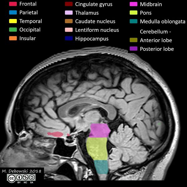 File:Brain lobes - annotated MRI (Radiopaedia 61691-69700 Sagittal 38).JPG