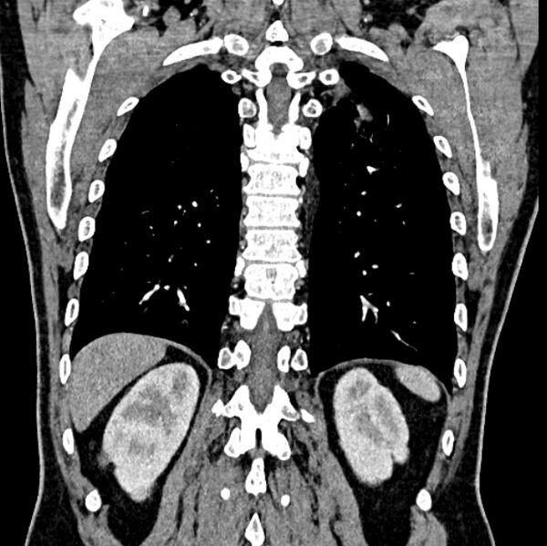File:Brain metastases - lung cancer primary (Radiopaedia 75060-86116 C+ arterial phase 53).jpg
