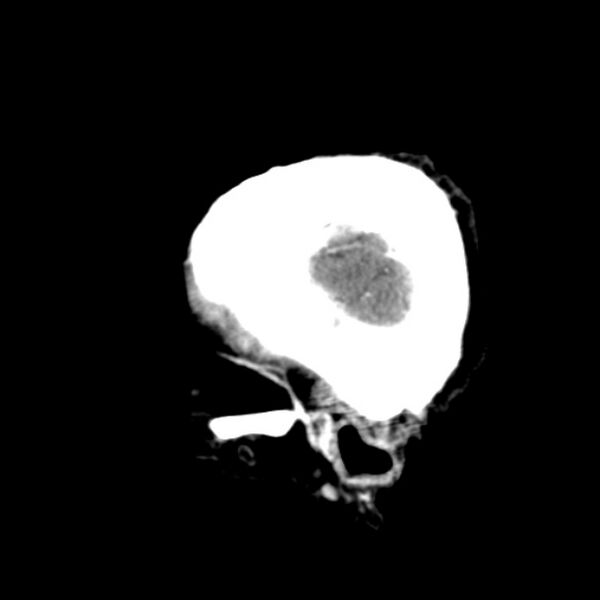 File:Brain metastases from lung cancer (Radiopaedia 24480-24781 C+ delayed 53).jpg