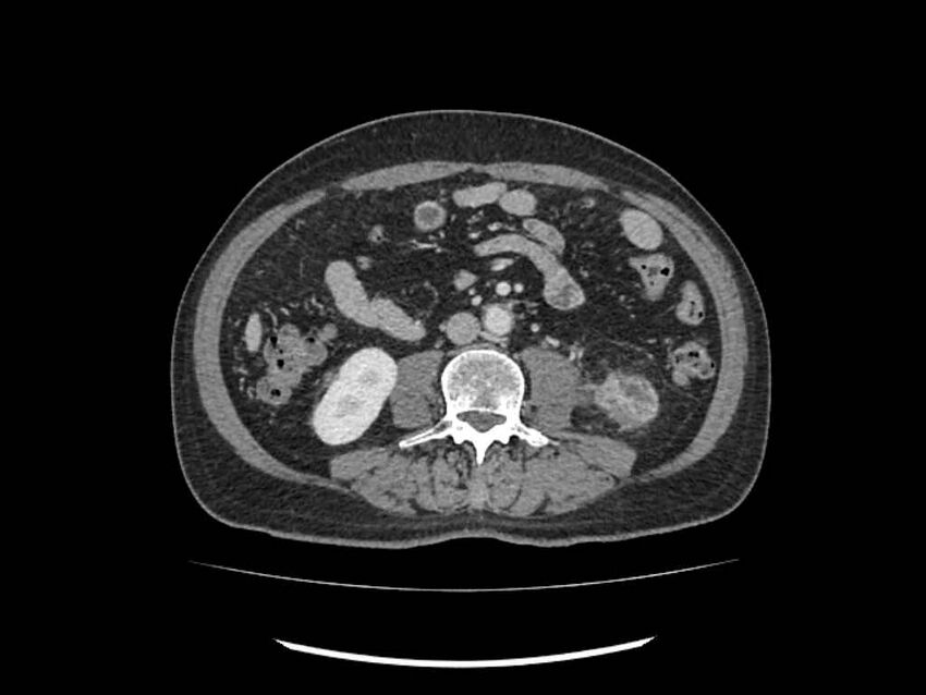 Brain metastases from renal cell carcinoma (Radiopaedia 42222-45328 B 153).jpg