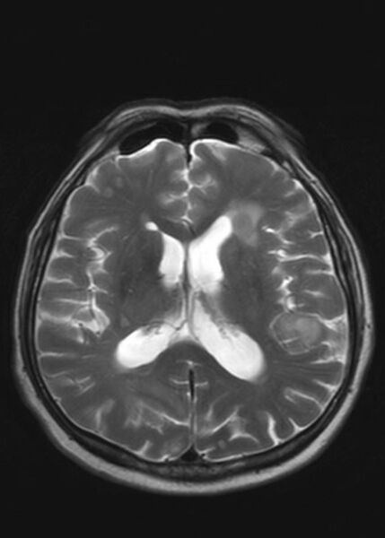 File:Brain metastases from squamocellular lung cancer (Radiopaedia 56515-63222 Axial T2 15).jpg