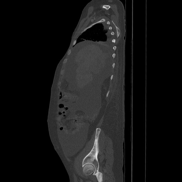 File:Breast cancer metastases - hepatic and skeletal (Radiopaedia 34201-35461 Sagittal bone window 25).jpg