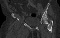 Breast carcinoma with pathological hip fracture (Radiopaedia 60314-67993 Coronal bone window 64).jpg