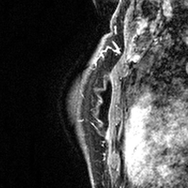 File:Breast implants - MRI (Radiopaedia 26864-27035 Sagittal T2 48).jpg