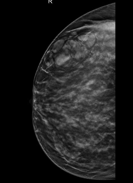 File:Breast within a breast sign - hamartoma (Radiopaedia 64005-72757 CC - Tomosynthesis 1).JPG