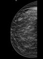 Breast within a breast sign - hamartoma (Radiopaedia 64005-72757 CC - Tomosynthesis 1).JPG
