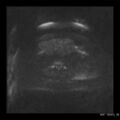 Broad ligament fibroid (Radiopaedia 49135-54241 Axial DWI 8).jpg