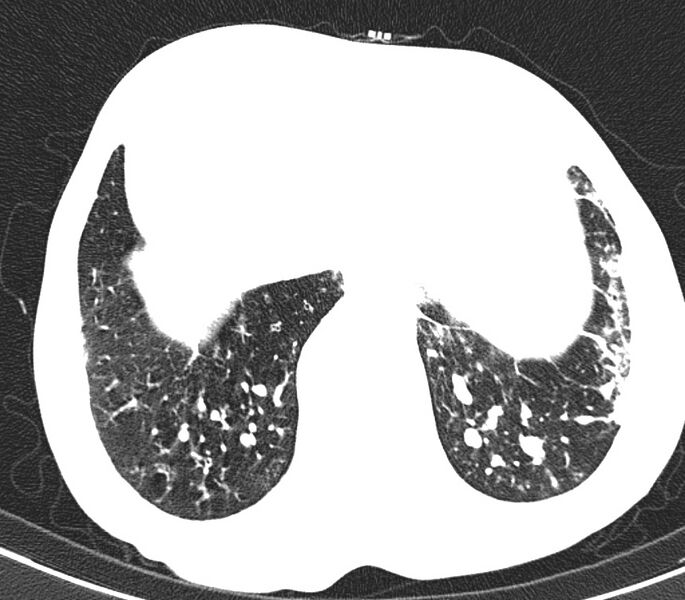 File:Bronchiolitis (Radiopaedia 24616-24887 Axial lung window 53).jpg