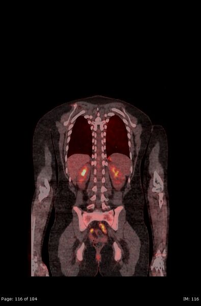 File:Brown fat uptake (FDG PET-CT) (Radiopaedia 77392-89513 Fused coronal 74).jpg