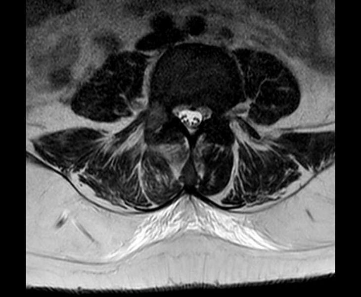 File:Brown tumors compressing the spinal cord (Radiopaedia 68442-78030 Axial T2 - lumbar 24).jpg