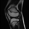 Bucket handle tear - lateral meniscus (Radiopaedia 72124-82634 Sagittal T2 4).jpg