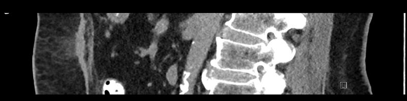 File:Buried bumper syndrome - gastrostomy tube (Radiopaedia 63843-72575 Sagittal Inject 59).jpg