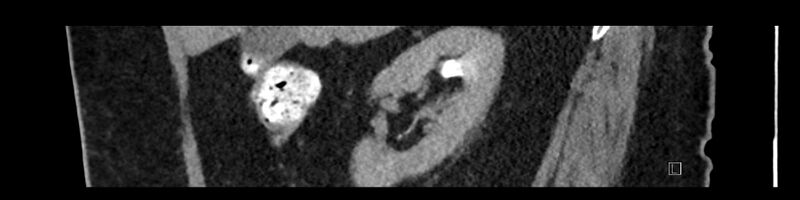 File:Buried bumper syndrome - gastrostomy tube (Radiopaedia 63843-72575 Sagittal Inject 86).jpg