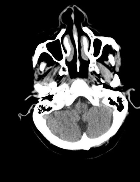 File:Burnt-out meningioma (Radiopaedia 51557-57337 Axial non-contrast 4).jpg