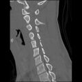 C5 facet fracture (Radiopaedia 58374-65499 Sagittal bone window 32).jpg