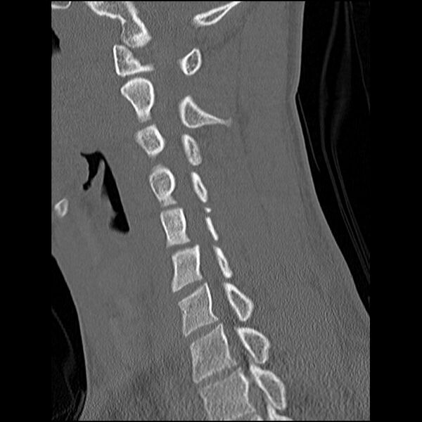 File:C5 facet fracture (Radiopaedia 58374-65499 Sagittal bone window 32).jpg