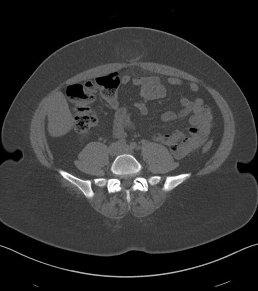 File:Calcified hepatic hydatid cyst (Radiopaedia 81127-94738 Axial non-contrast 65).jpg