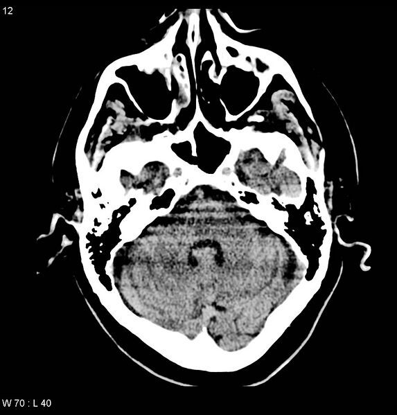 File:Calcified left middle cerebral artery embolism (Radiopaedia 5570-22120 Axial non-contrast 1).jpg