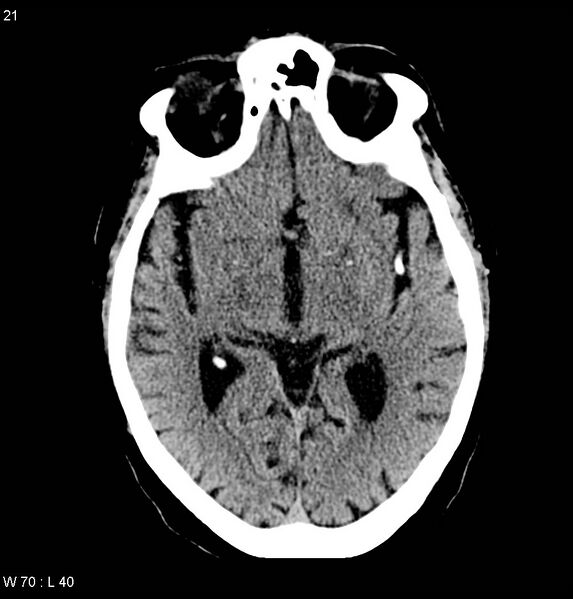 File:Calcified left middle cerebral artery embolism (Radiopaedia 5570-22120 Axial non-contrast 4).jpg