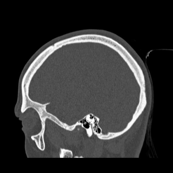 File:Calvarial osteoma (Radiopaedia 36520-38079 Sagittal bone window 82).jpg