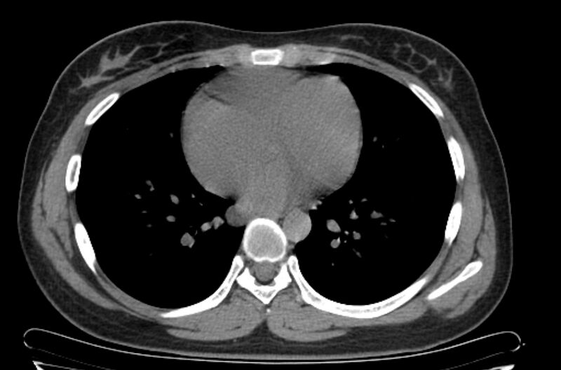 File:Cannonball metastases - uterine choriocarcinoma (Radiopaedia 70137-80173 Axial non-contrast 75).jpg